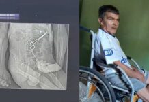 Polícia Civil indicia três profissionais de saúde por homicídio culposo após paciente morrer com pinça esquecida no abdômen